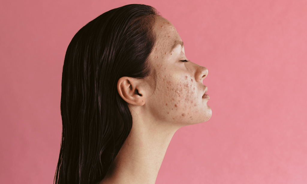 PCOS Acne: Symptoms and Treatments - The S’moo Co