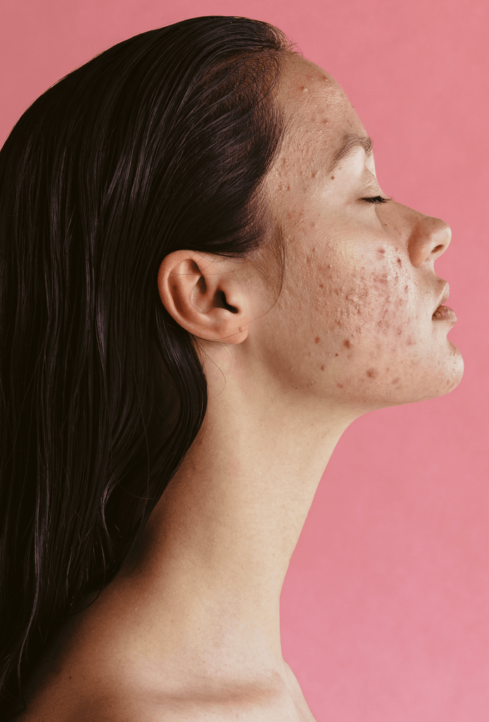 Using Spironolactone to Treat Acne: What you should know! - The S’moo Co